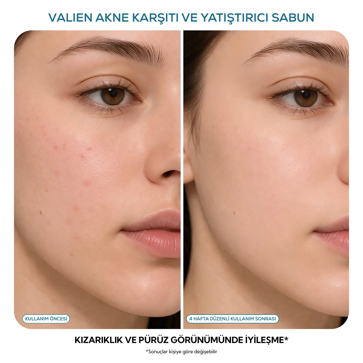Akne Sabunu: Akne Karşıtı & Yatıştırıcı Sabun (90 gr)