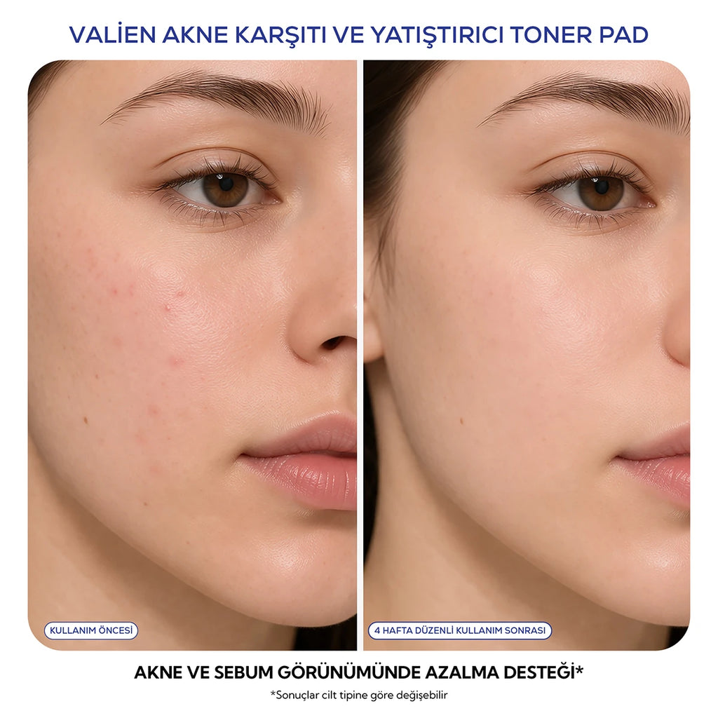 Akne Karşıtı & Yatıştırıcı - Toner Pad (60 Adet)
