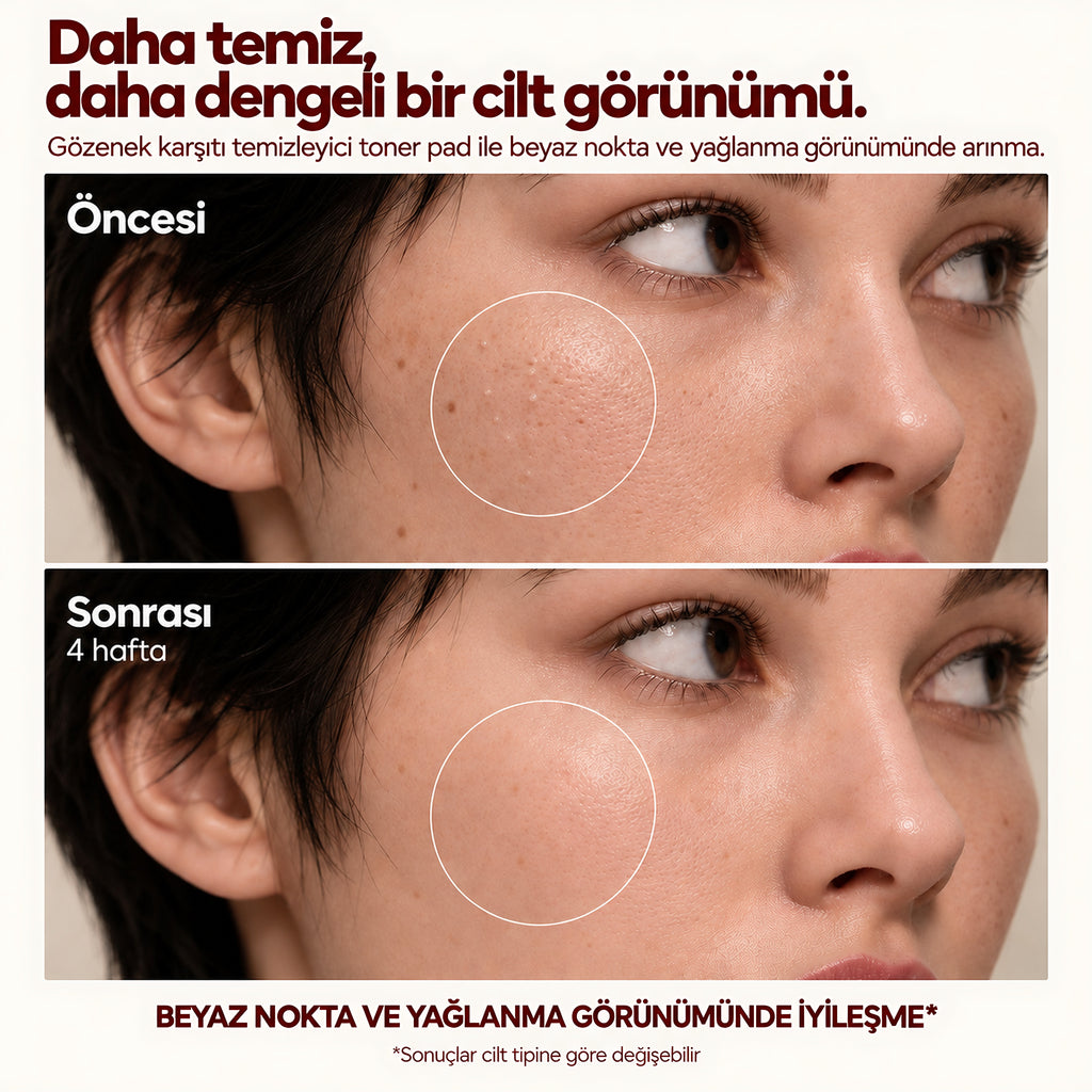 Valien Gözenek Karşıtı & Temizleyici Toner Pad — öncesi ve sonrası karşılaştırma görseli
