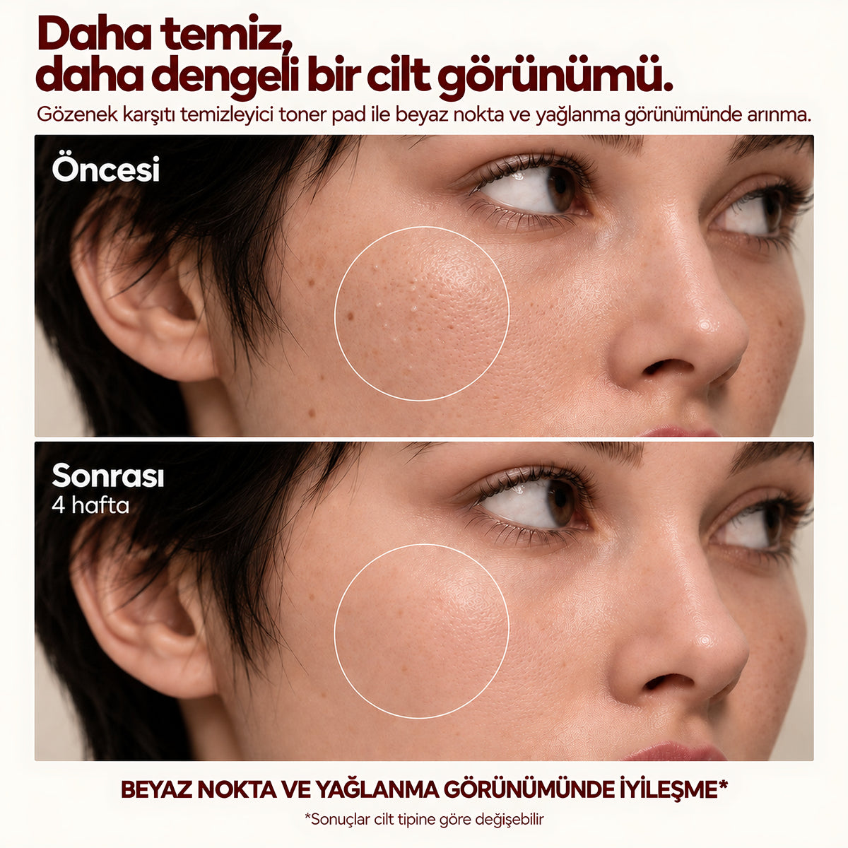 Valien Gözenek Karşıtı & Temizleyici Toner Pad — öncesi ve sonrası karşılaştırma görseli