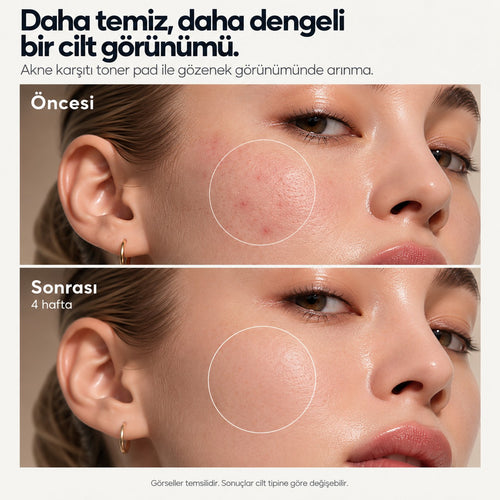 VÀLIEN Akne Toner Pad — öncesi ve sonrası karşılaştırma görseli
